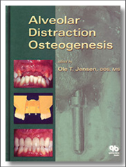 Alveolar Distraction Osteogenesis, Ole T. Jensen, Quintessence Publishing